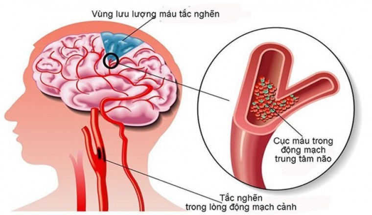 Sự thật về hoạt huyết dưỡng não tăng cường trí nhớ