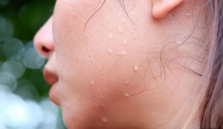Vã nhiều mồ hôi sử dụng những bài thuốc đông y này rất hiệu quả