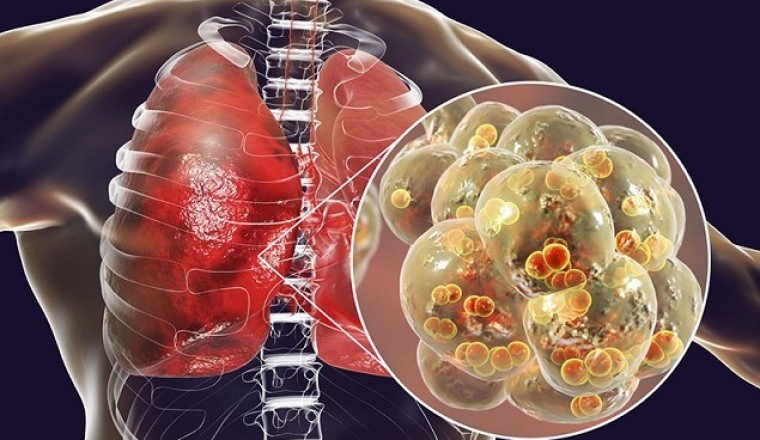 SARS-CoV-2 tấn công phổi như thế nào?