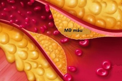 Bệnh mỡ máu cao và mười bài thuốc đông y hỗ trợ điều trị dứt điểm