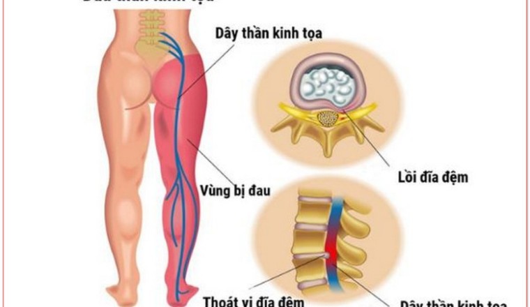 Trị đau thần kinh tọa hiệu quả bằng bài thuốc đông y
