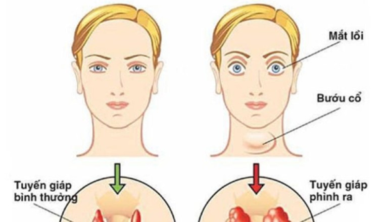 Bệnh Basedow, Cường giáp các phương pháp và thuốc chữa trị
