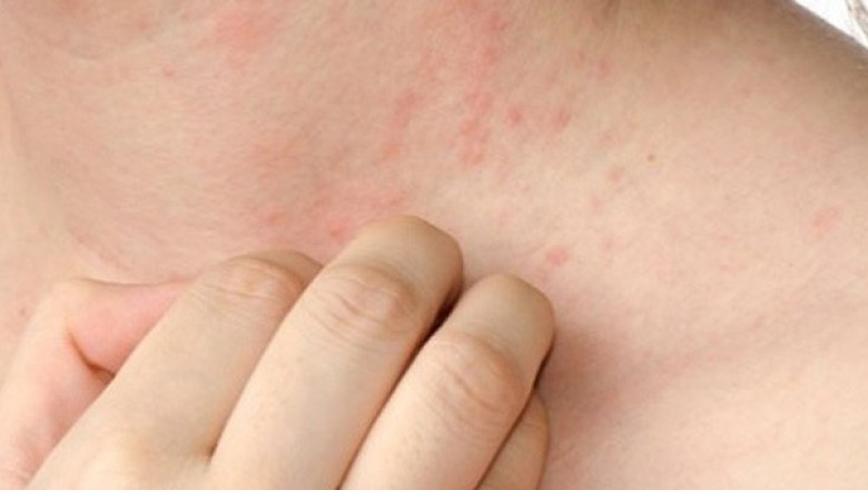 Cách chữa bị di chứng người mẩn ngứa hậu covid