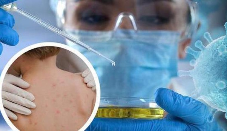 Đường lây truyền và cách phòng ngừa cần làm ngay để phòng bệnh Đậu mùa khỉ