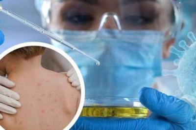 Đường lây truyền và cách phòng ngừa cần làm ngay để phòng bệnh Đậu mùa khỉ