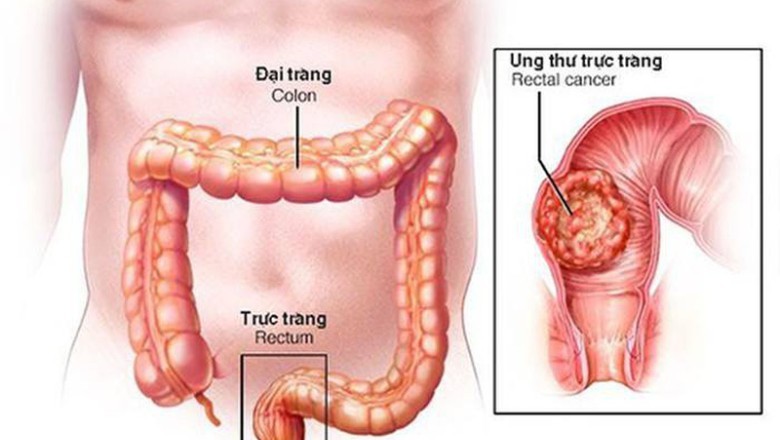 Những người đầu tiên trên thế giới được chữa khỏi hoàn toàn bệnh Ung thư trực tràng