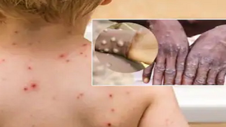 Phân biệt bệnh đậu mùa khỉ và bệnh thủy đậu
