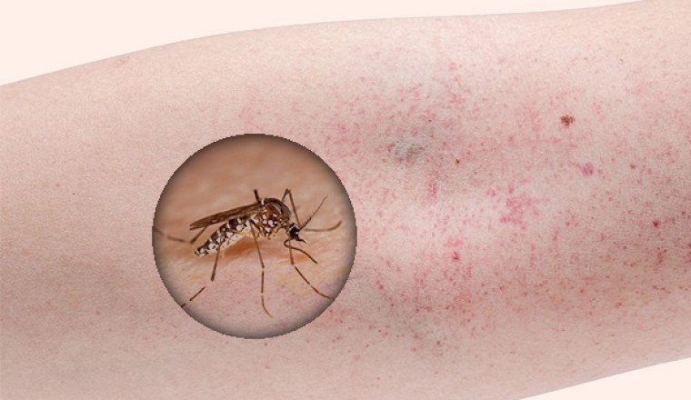 Lào lo ngại bùng phát dịch sốt xuất huyết
