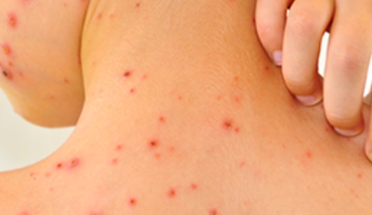 Bài thuốc đông y điều trị sốt xuất huyết