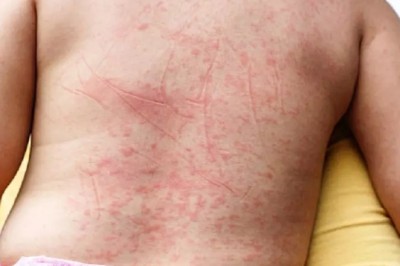 Dấu hiệu nhận biết sốt xuất huyết và chăm sóc bệnh nhân sốt xuất huyết đúng cách