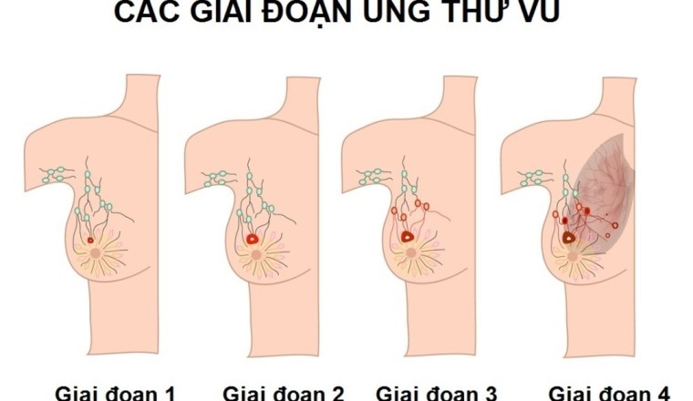 Phát hiện mới trong điều trị ung thư vú