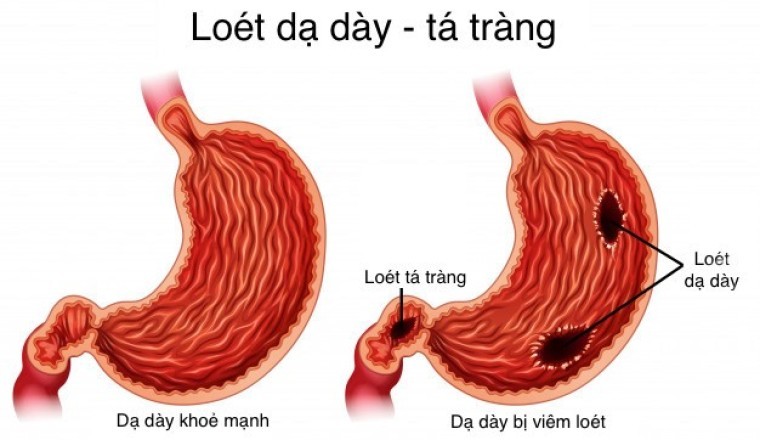 Cây thuốc nam, cây thảo mộc, thảo dược giúp giảm viêm loét dạ dày