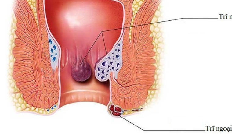 Cách điều trị bệnh trĩ tại nhà bằng thuốc nam hiệu quả nhất