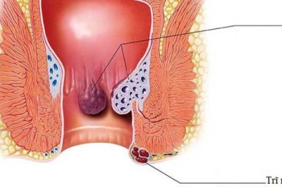Cách điều trị bệnh trĩ tại nhà bằng thuốc nam hiệu quả nhất