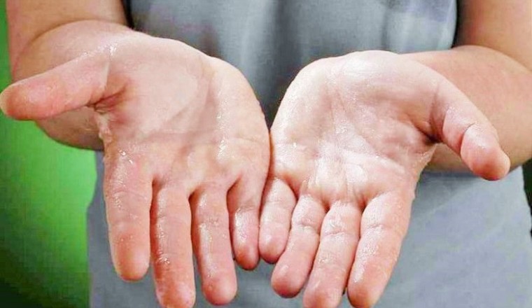 Bài thuốc chữa bệnh mồ hôi tay chân