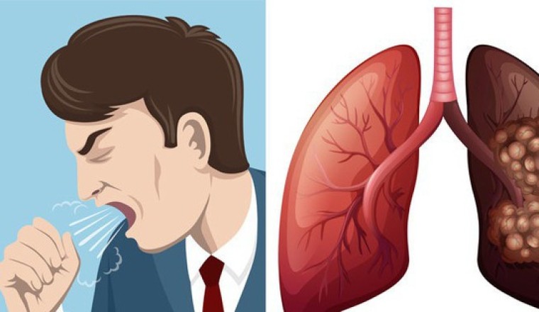 Ung thư phổi liệu có di truyền?