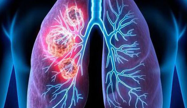 2 người trong cùng một nhà mắc ung thư phổi: Bác sĩ chỉ ra nguyên nhân