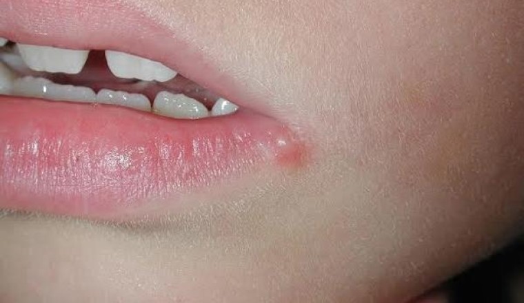 Những cách chữa mụn rộp do herpes tại nhà
