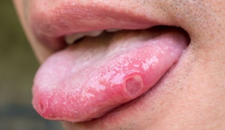 Ung thư lưỡi - triệu chứng dễ nhầm với viêm, nhiệt miệng