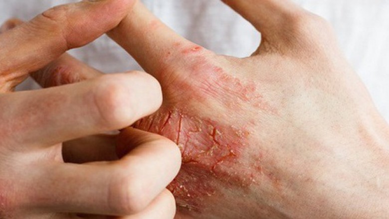 2 bộ phận trên cơ thể bị ngứa là dấu hiệu mắc bệnh tiểu đường