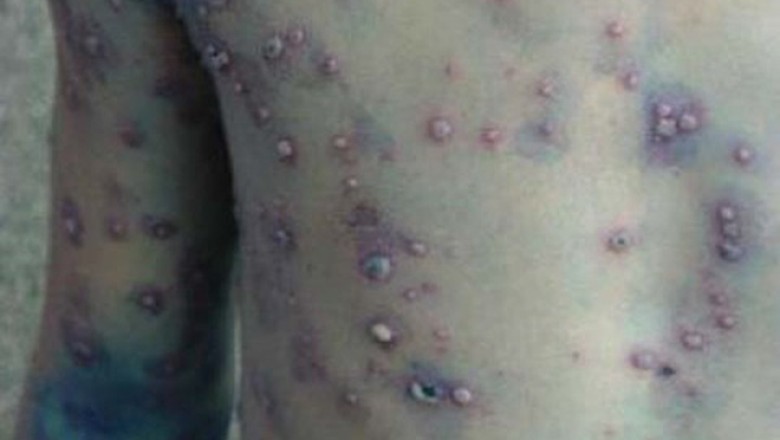 Món ăn là thuốc chữa bệnh thuỷ đậu giúp nhanh khỏi thuỷ đậu