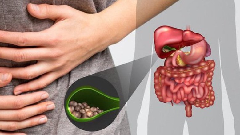 Bệnh polyp túi mật nguyên nhân và điều trị polyp túi mật