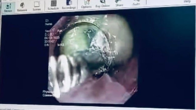 Nuốt mật lợn chữa đau bụng theo dân gian, người phụ nữ nguy kịch