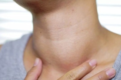 Số người mắc ung thư tuyến giáp ngày càng tăng ở cả Nam và Nữ