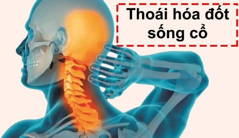 Các bài thuốc điều trị thoái hóa đốt sống cổ