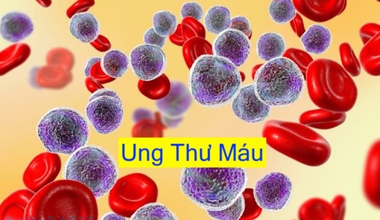 Bác sĩ cảnh báo những dấu hiệu ban đầu ung thư máu thường bị nhiều người bỏ qua