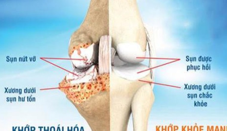 Bài thuốc làm chậm bệnh thoái hóa xương khớp
