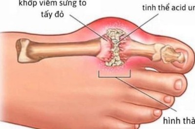 Phòng bệnh gout tái phát bằng món ăn bài thuốc đơn giản tại nhà
