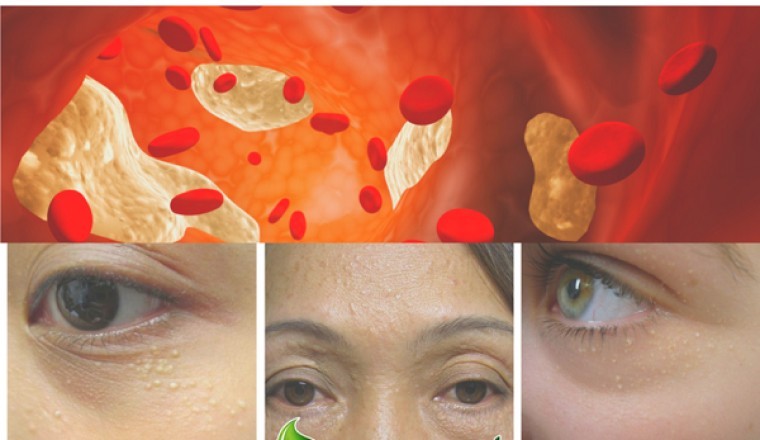 Dấu hiệu cảnh báo cholesterol cao có thể xuất hiện ở mắt