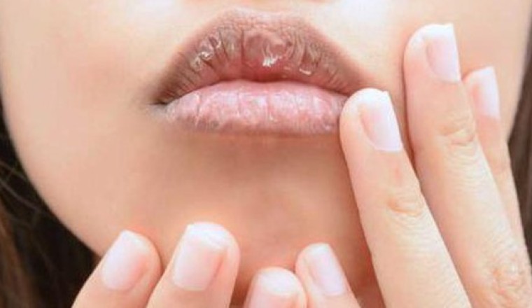Môi khô, nứt nẻ, đau rát khó lành cảnh giác với ung thư môi