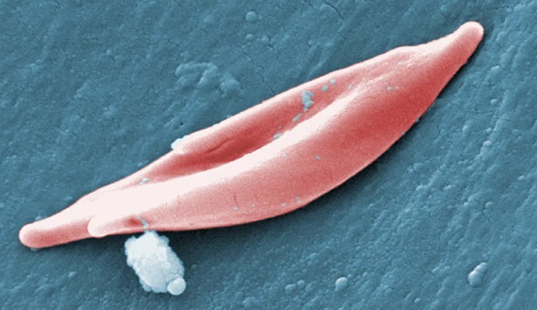 Mỹ phê duyệt liệu pháp chỉnh sửa gene điều trị bệnh hồng cầu hình liềm mang tính cách mạng