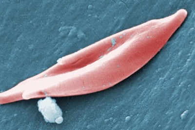 Mỹ phê duyệt liệu pháp chỉnh sửa gene điều trị bệnh hồng cầu hình liềm mang tính cách mạng