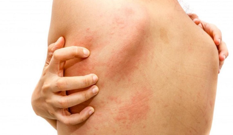Ngứa da dầu, người đàn ông qua đời sau 3 tháng: 4 cơn ngứa cảnh báo bệnh nặng hoặc ung thư