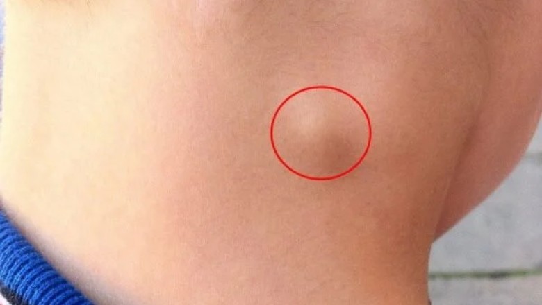 Trẻ nổi hạch như nào là bình thường, như nào là bất thường?