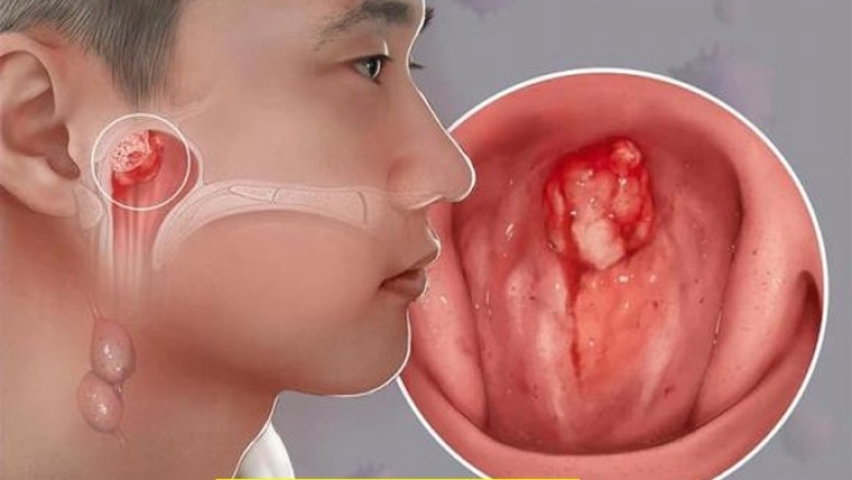 Ung thư vòm họng rất ít biểu hiện ở giai đoạn đầu đây là 5 triệu chứng dễ bỏ qua ở giai đoạn đầu nên đặc biệt chú ý
