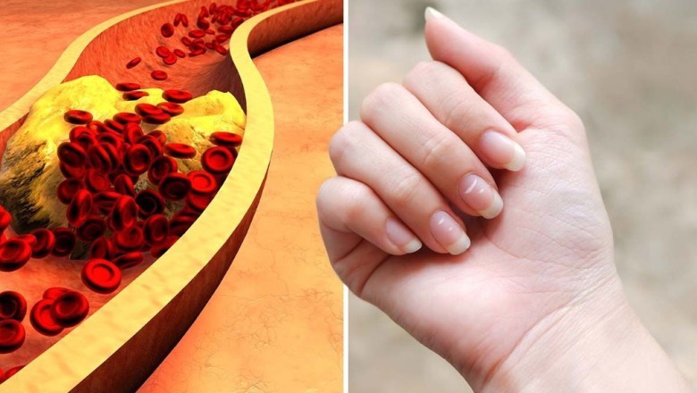 7 Dấu Hiệu Bàn Tay Báo Hiệu Cholesterol Cao Ở Nam Giới