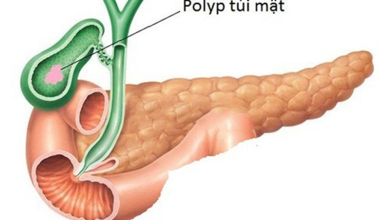 Hiểu Biết Về Polyp Túi Mật: Nguyên Nhân, Triệu Chứng và Cách Điều Trị