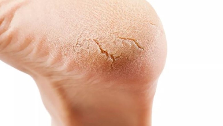 Soi Bàn Chân Mà Thấy Dấu Hiệu Này, Cẩn Thận Gan Suy Hỏng, Mất Chức Năng Từ Bao Giờ