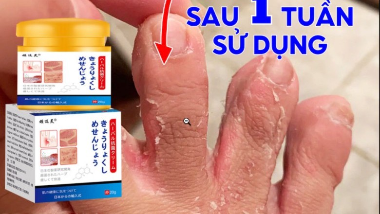 Giới Thiệu Sản Phẩm: Kem Bôi Viêm Da Cơ Địa NHẬT BẢN cần có trong Mùa mưa lũ